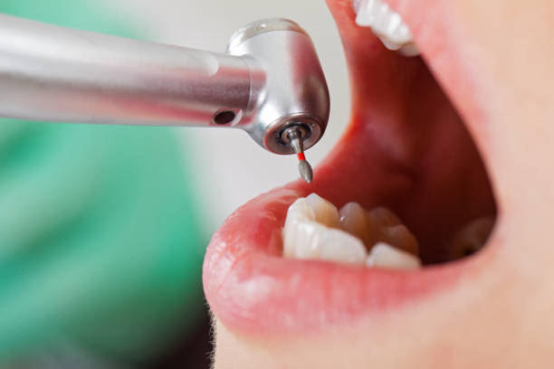 Best Emergency Dentist for Lost Fillings or Crowns in Capitol View, SC